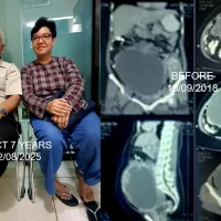 Kanker Ovarium Sudah Menyebar ke Jaringan Omentum, Bisa Remisi Melewati 7 Tahun dengan ECCT tanpa Kemo