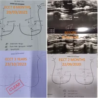 Usia 24 Tahun Didiagnosa Kanker Payudara, Bisa Bersih tanpa Operasi dengan ECCT