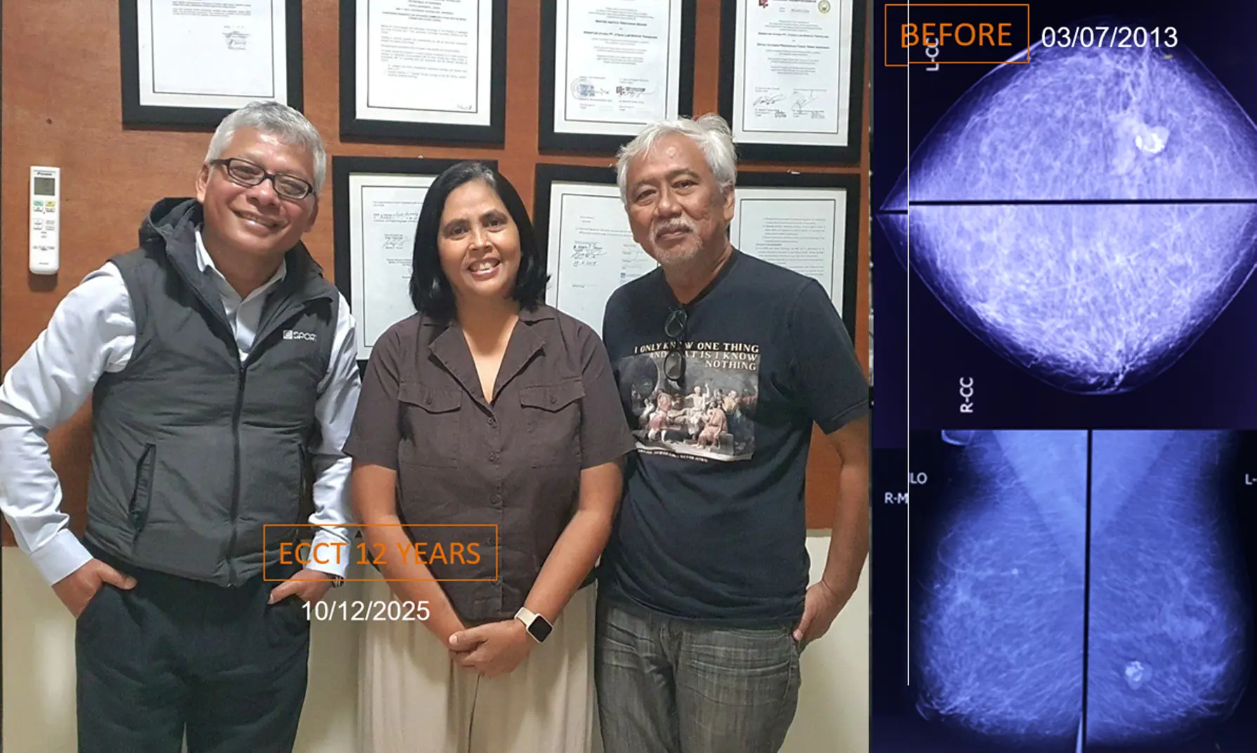 Benjolan di Payudara Kanan dan Kiri, Ginjal dan Tiroid, Tak Mau Operasi/biopsi, Melewati 12 Tahun dengan ECCT.