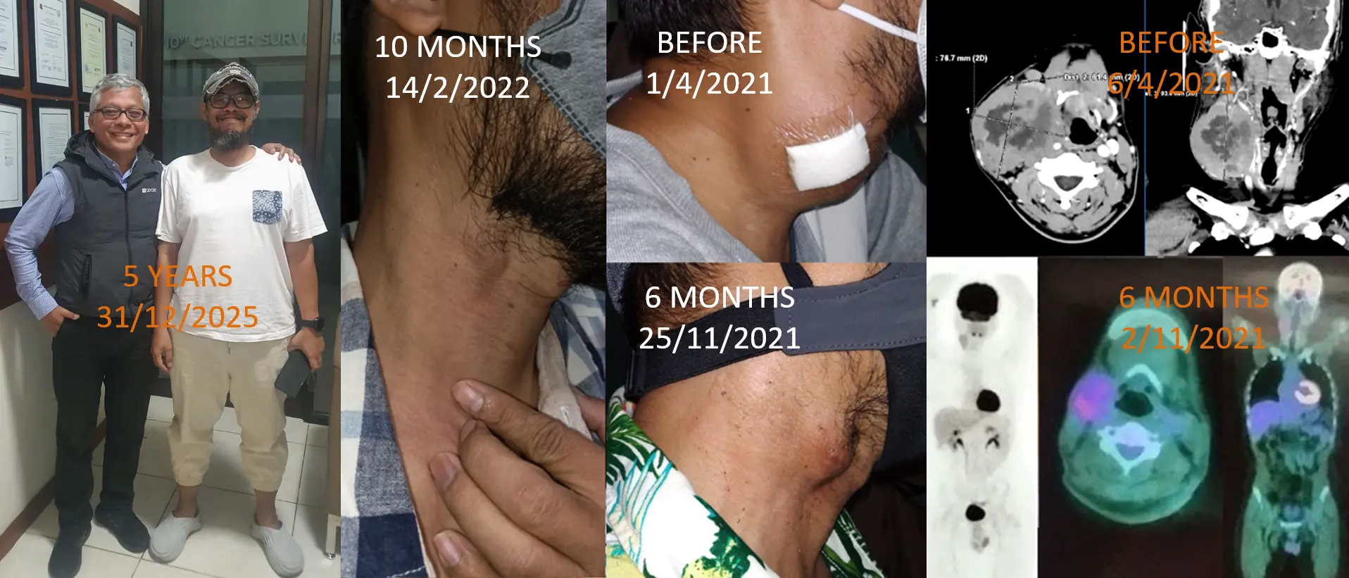 Kanker Neuroendokrin Tak Mempan dengan Kemoterapi, Baru Bisa Mengecil hingga Bersih setelah Tambah ECCT Melewati 5 Tahun
