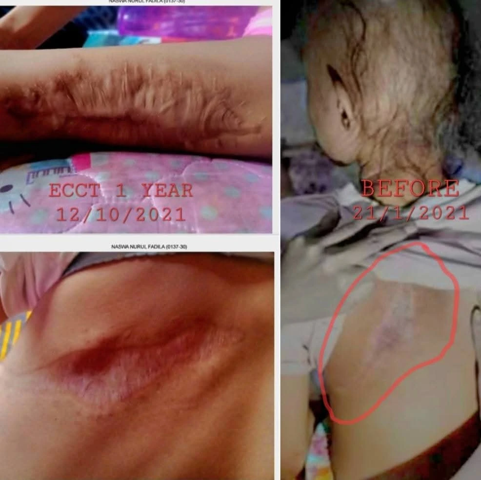 Gambar: Foto bagian otot punggung sebelum dan sesudah pakai ECCT selama kurang dari setahun.