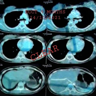Gambar: Hasil MRI setelah pemakaian setahun ECCT yang menunjukkan sudah bersih.