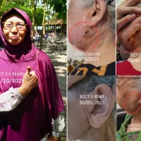 Usia 80 Tahun Harus Berhadapan dengan Kanker Limfoma, Bisa Terbebas dengan ECCT tanpa Kemo tanpa Operasi
