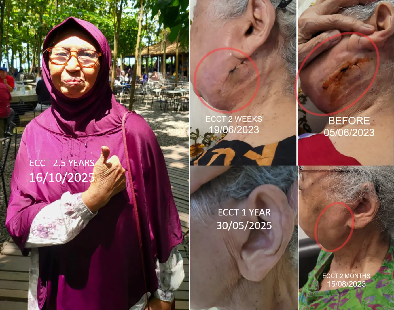 Usia 80 Tahun Harus Berhadapan dengan Kanker Limfoma, Bisa Terbebas dengan ECCT tanpa Kemo tanpa Operasi