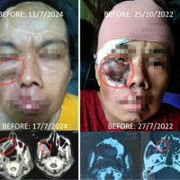 8 Tahun Massa Tumor di Rahang Terus Muncul Kembali meskipun Berkali-kali Operasi dan Radiasi, Baru Berhenti Tumbuh setelah Pakai ECCT