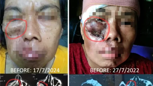 8 Tahun Massa Tumor di Rahang Terus Muncul Kembali meskipun Berkali-kali Operasi dan Radiasi, Baru Berhenti Tumbuh setelah Pakai ECCT