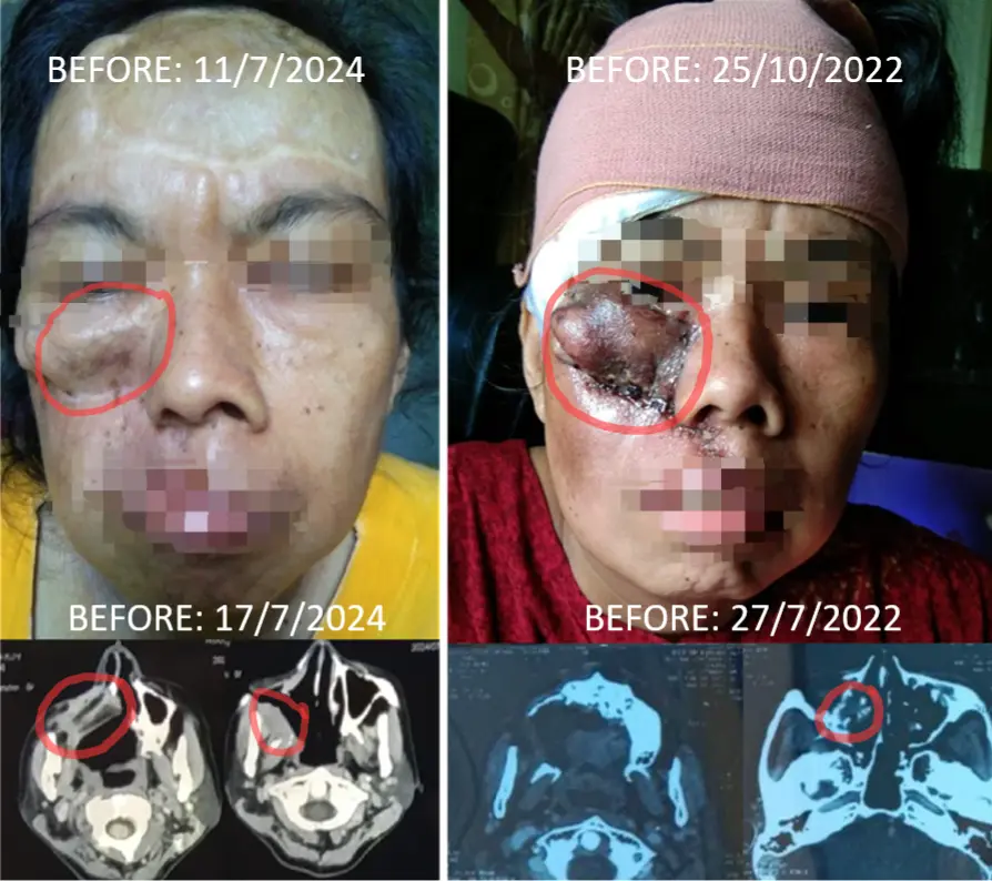 8 Tahun Massa Tumor di Rahang Terus Muncul Kembali meskipun Berkali-kali Operasi dan Radiasi, Baru Berhenti Tumbuh setelah Pakai ECCT