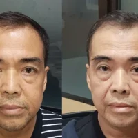 Dua potret Pak Prasetyo, dokumentasi kisah kanker nasofaring dan tiroid