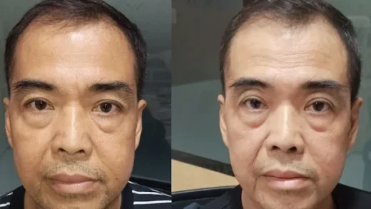 Dua potret Pak Prasetyo, dokumentasi kisah kanker nasofaring dan tiroid